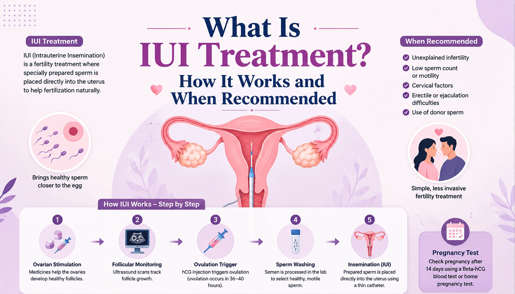 What Is IUI Treatment? How It Works and When Recommended – illustration showing the IUI treatment process, sperm preparation, and insemination